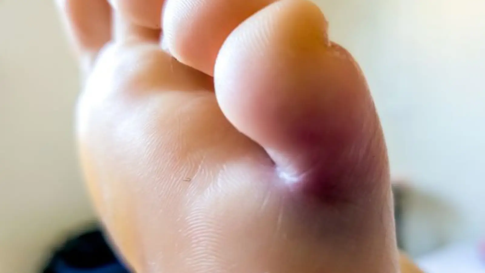 How Do I Know If My Toe Is Broken or Just Bruised